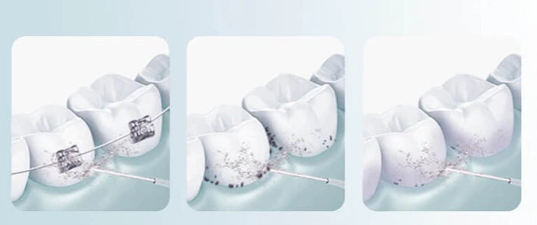 WaterFloss Pro - Tar bort smutsen som tandborsten inte får bort